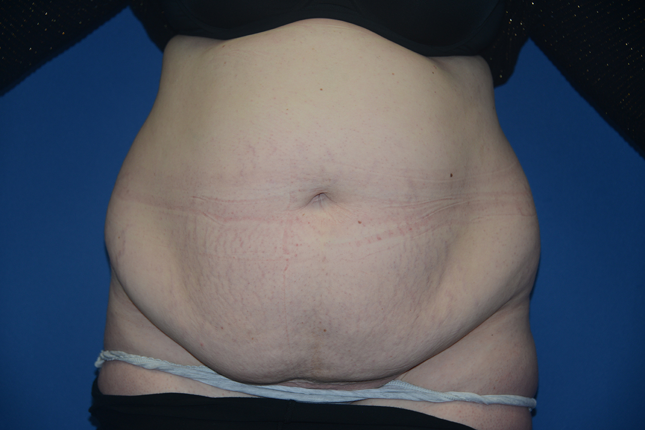 Abdominoplasty Case 34