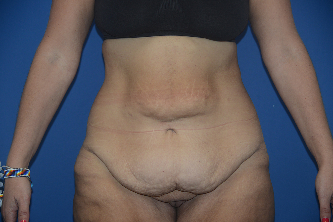 Abdominoplasty Case 35