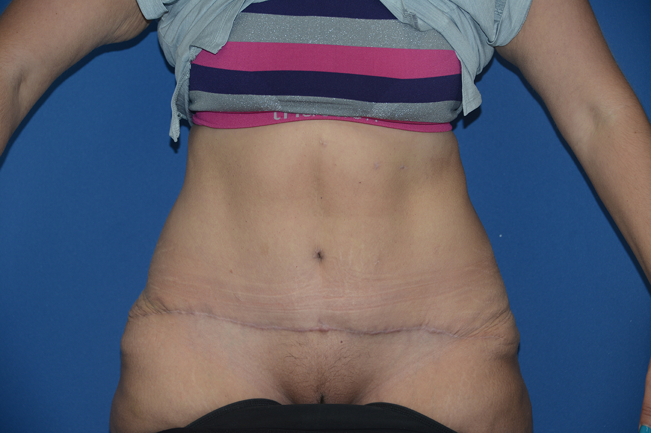 Abdominoplasty Case 35