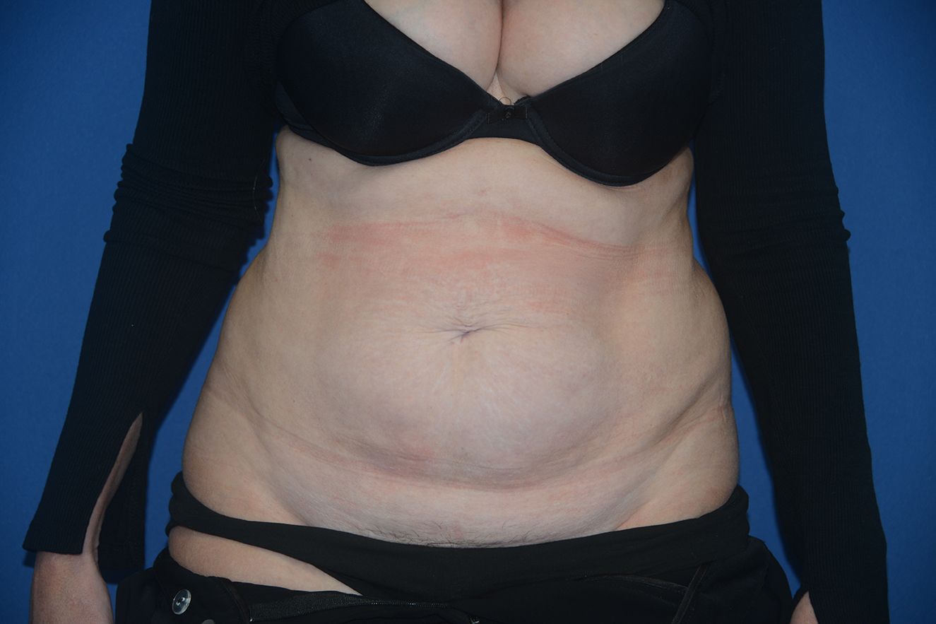 Abdominoplasty Case 36