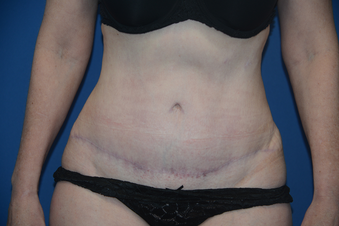 Abdominoplasty Case 36