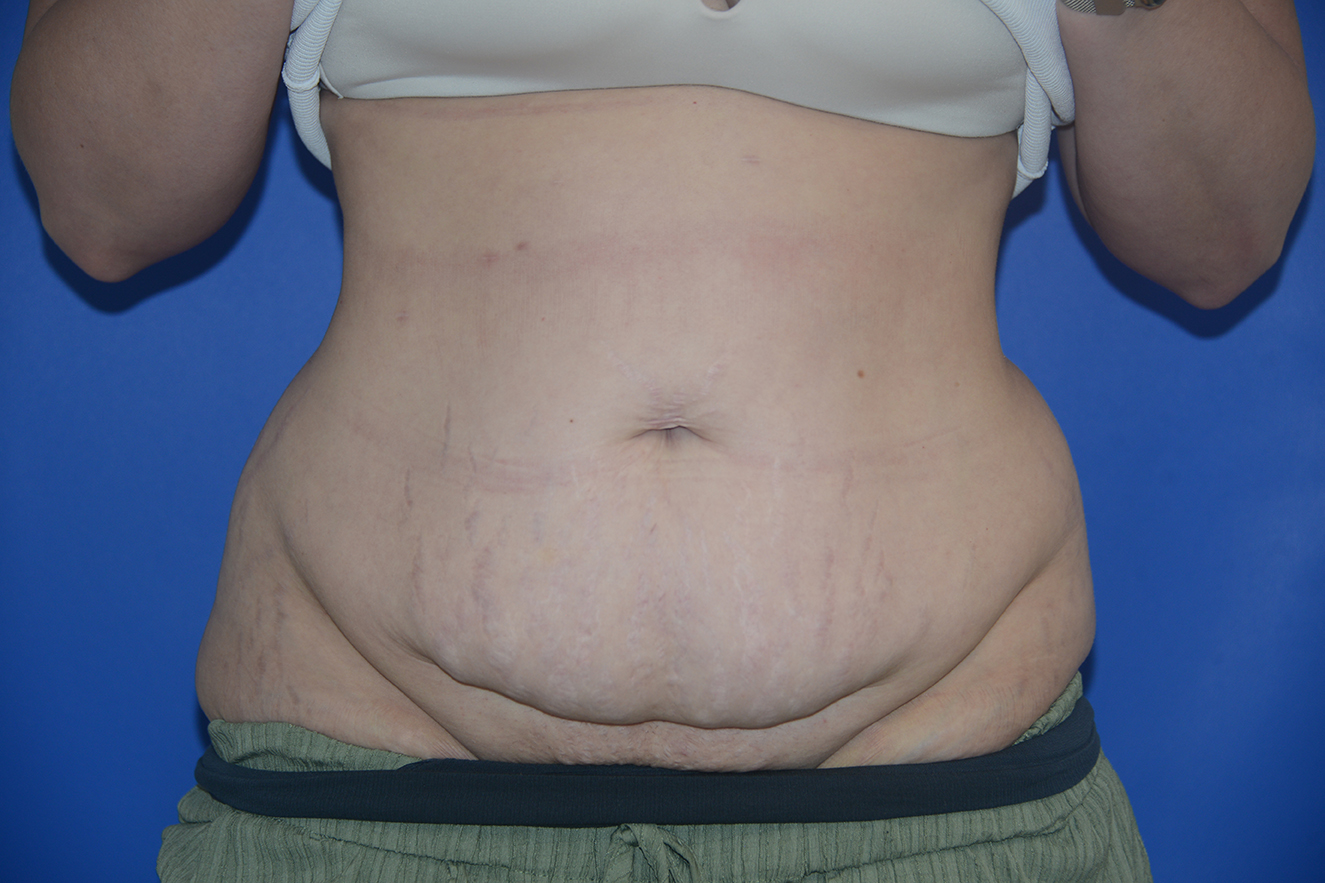 Abdominal Lipectomy Case 37