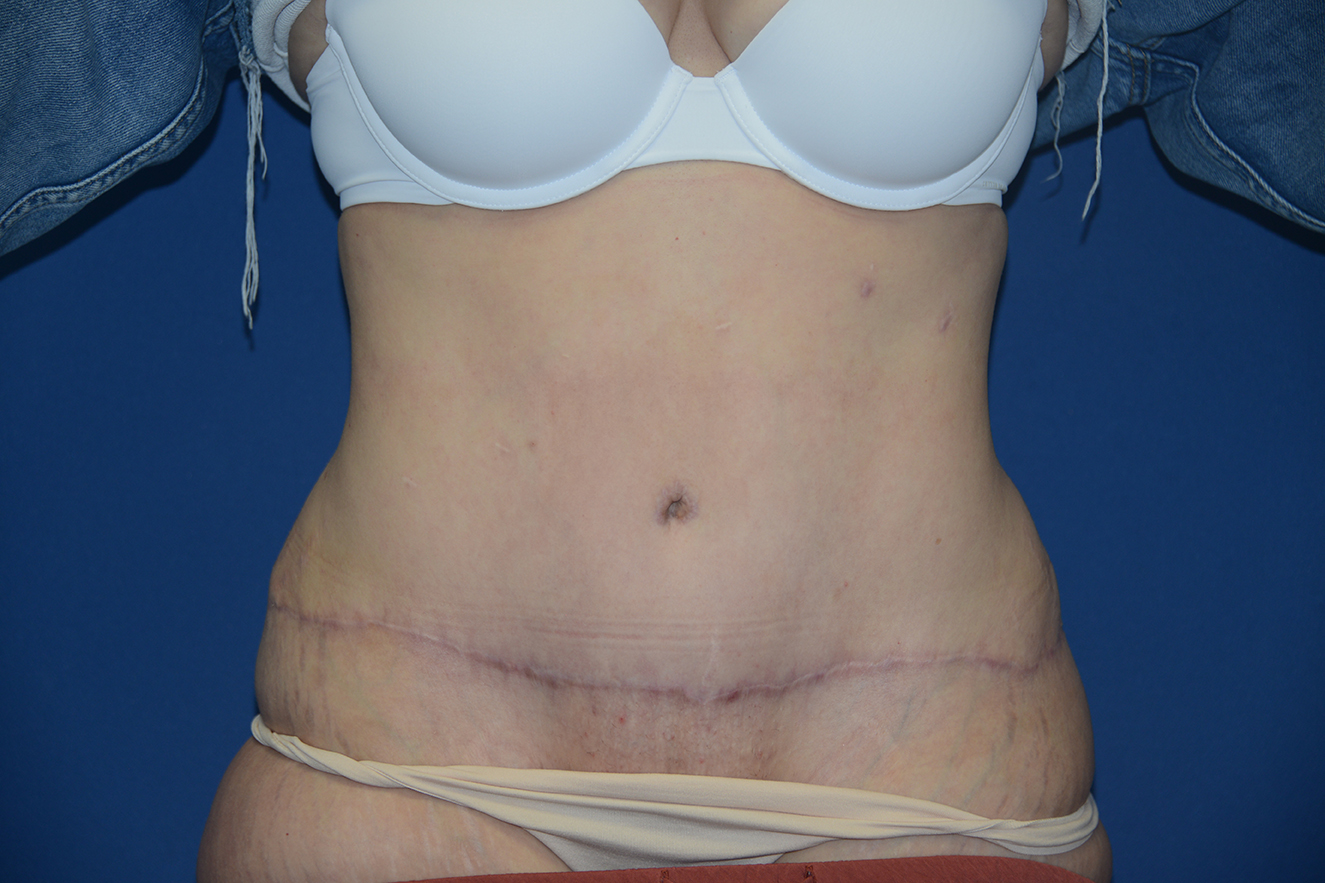 Abdominal Lipectomy Case 37