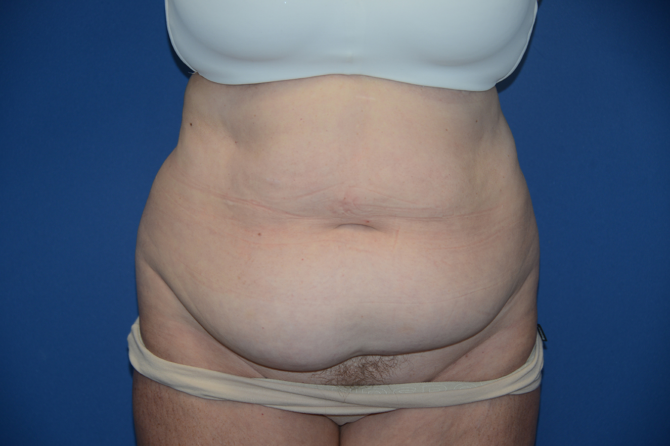 Abdominoplasty Case 38
