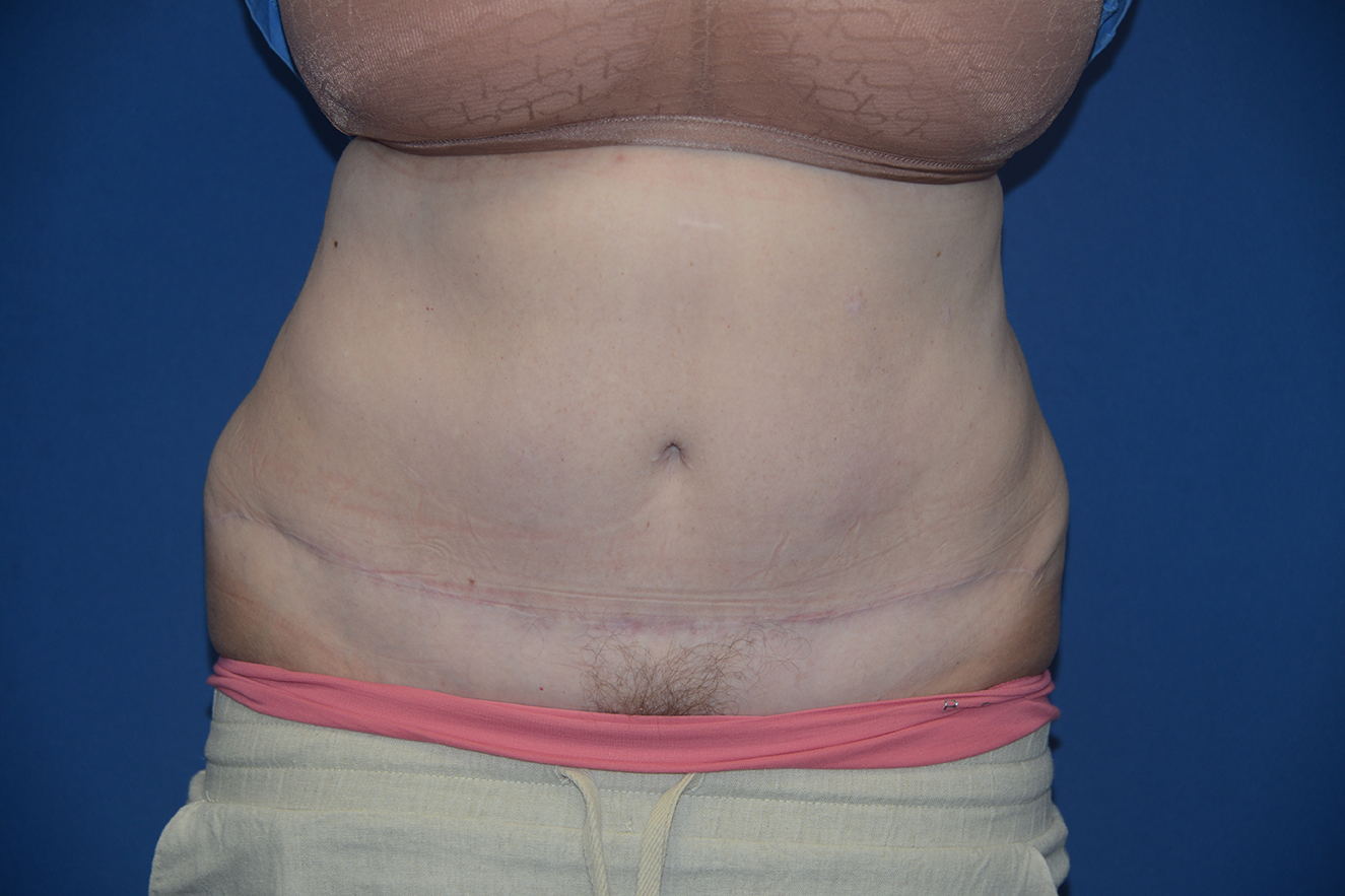 Abdominoplasty Case 38