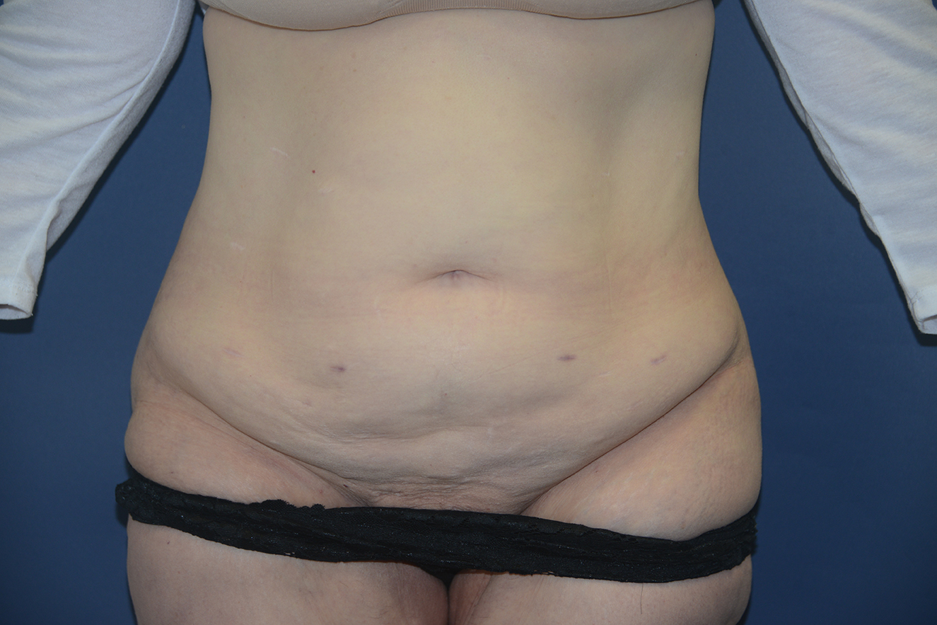 Abdominoplasty Case 39