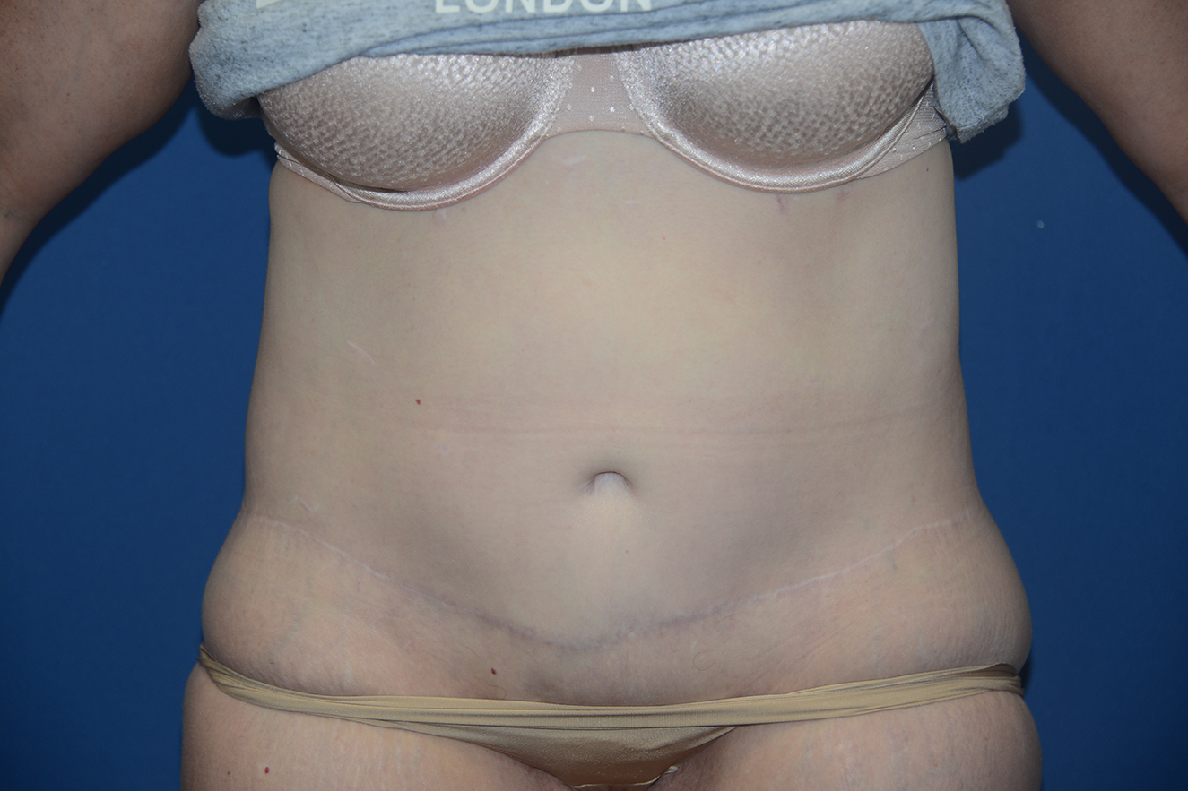Abdominoplasty Case 39