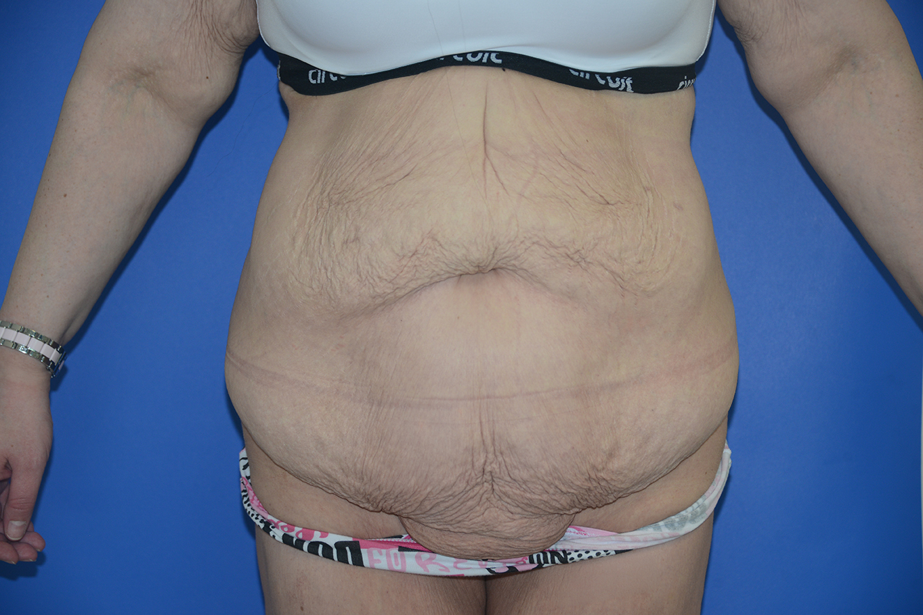 Abdominoplasty Case 40
