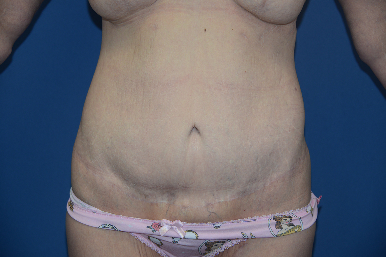 Abdominoplasty Case 40