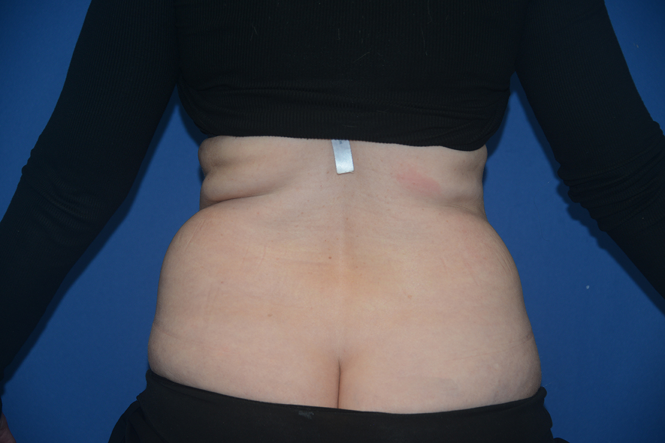 Liposuction Case 15