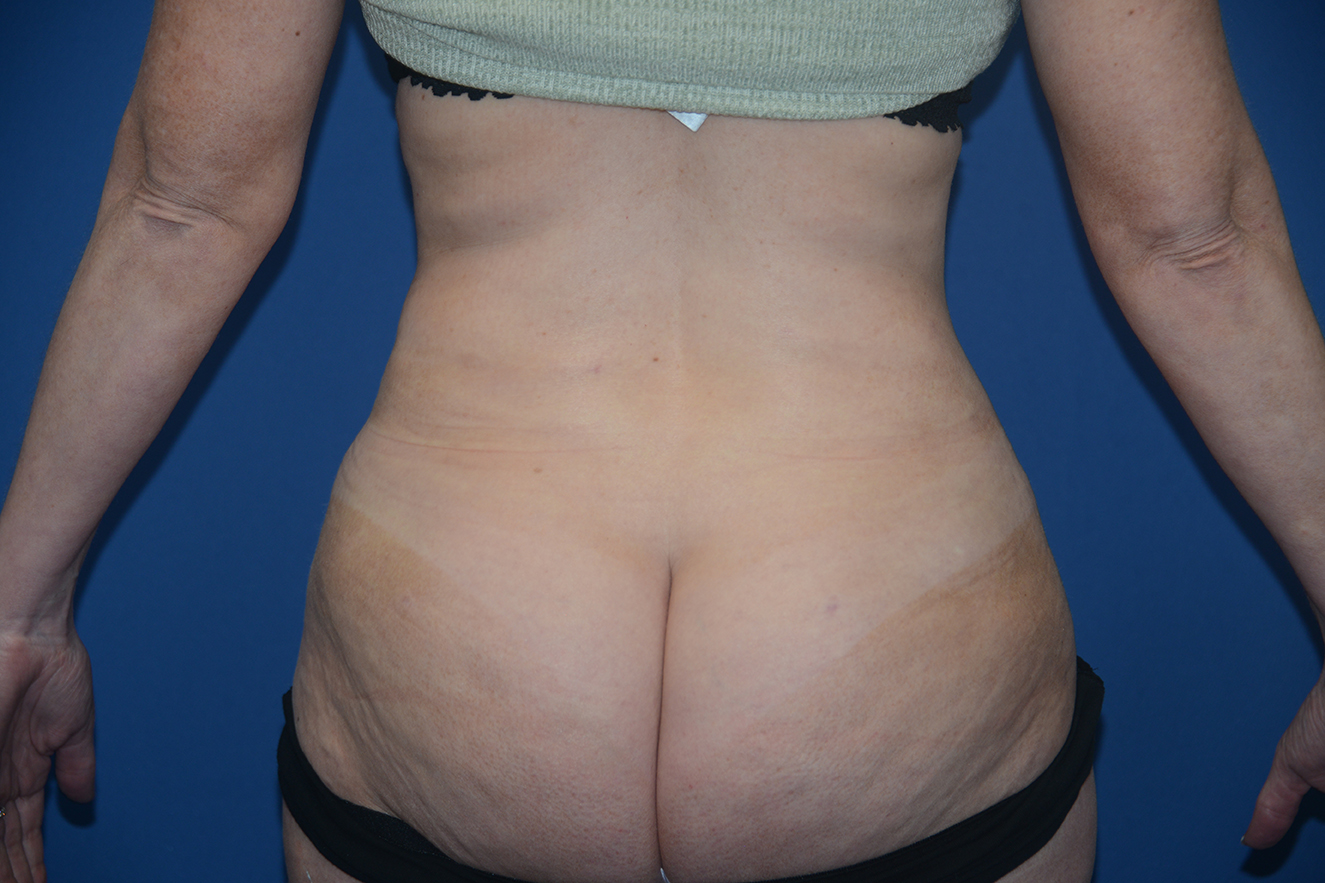 Liposuction Case 15