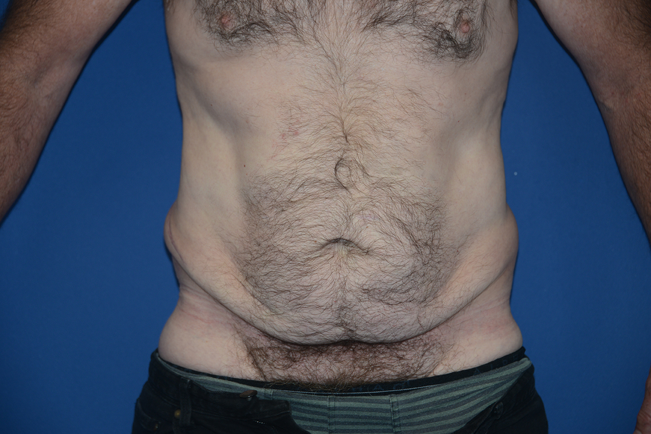 Abdominoplasty Case 41
