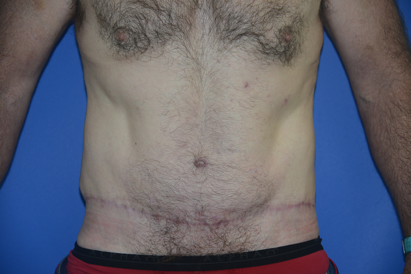 Abdominoplasty Case 41