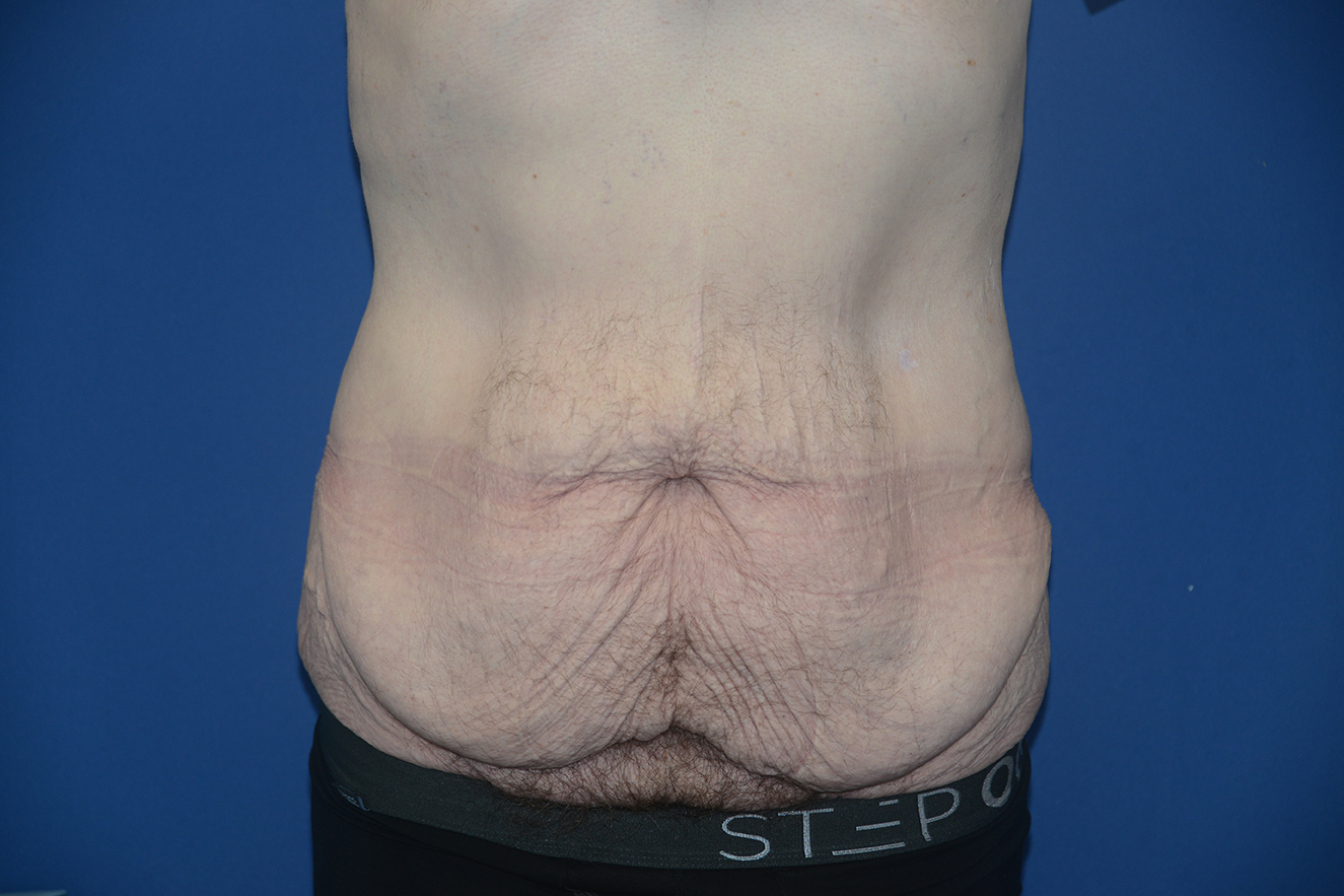 Abdominoplasty Case 42