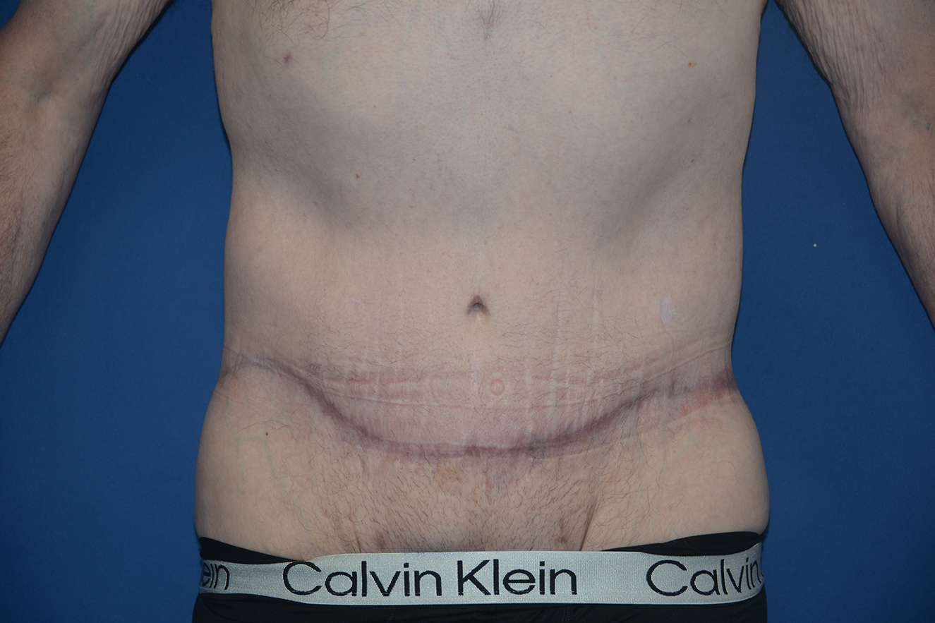 Abdominoplasty Case 42