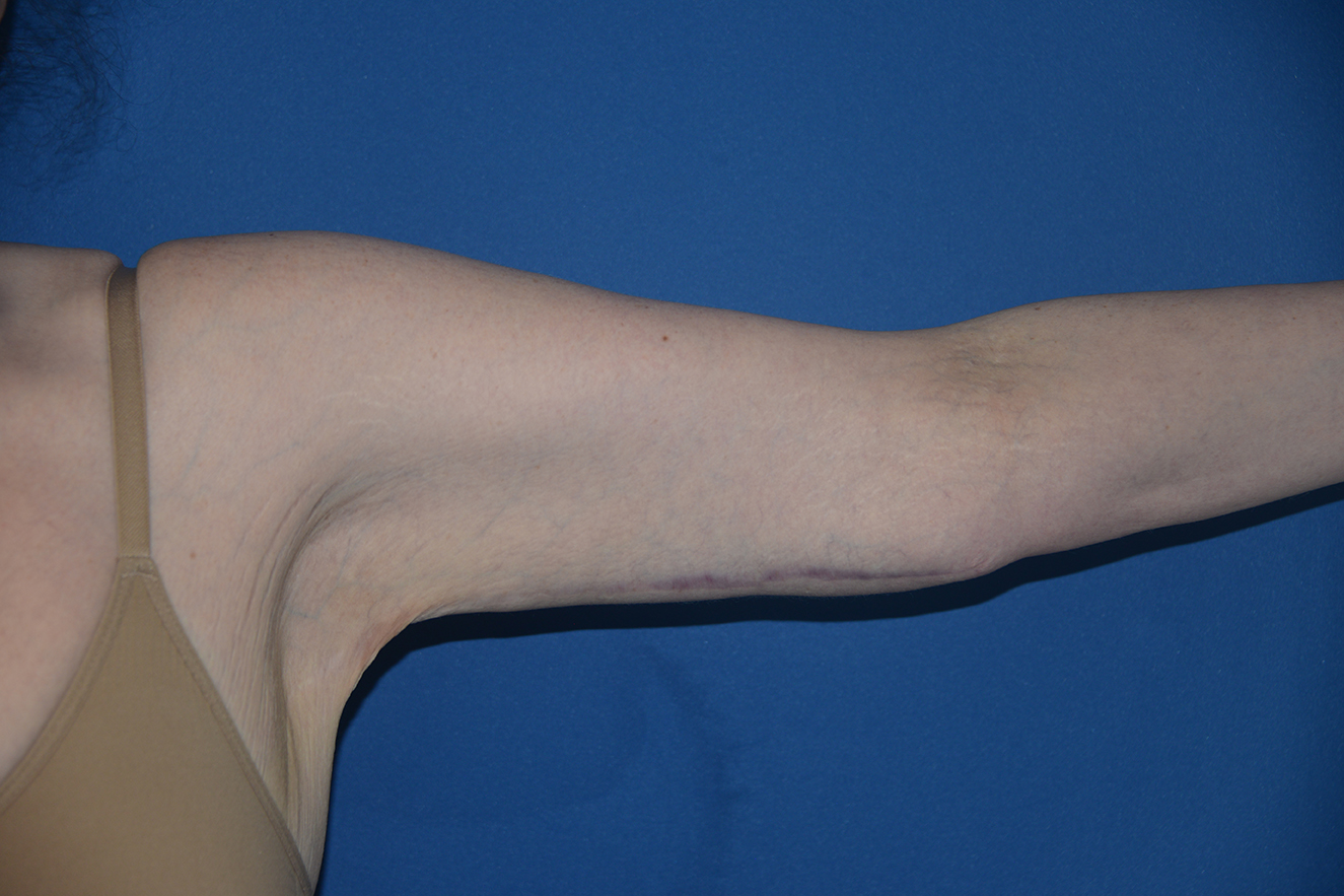 Arm Lift Case 7