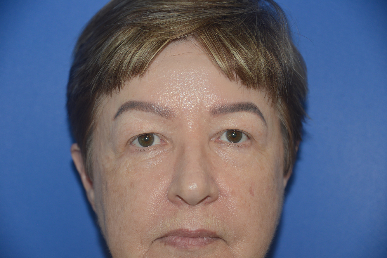Blepharoplasty (Eyelid Surgery) Case 18