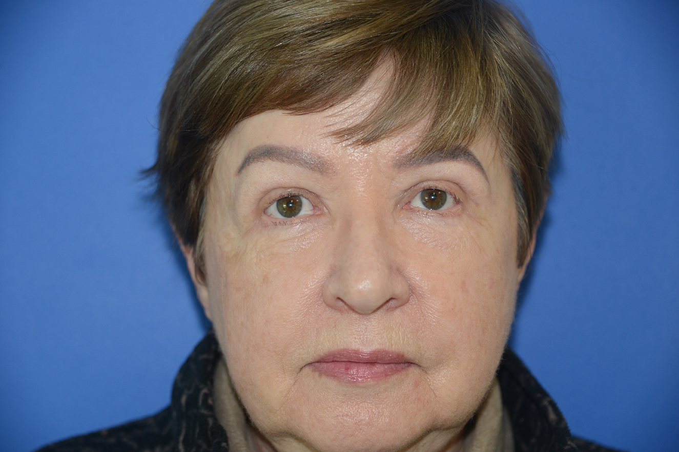 Blepharoplasty (Eyelid Surgery) Case 18