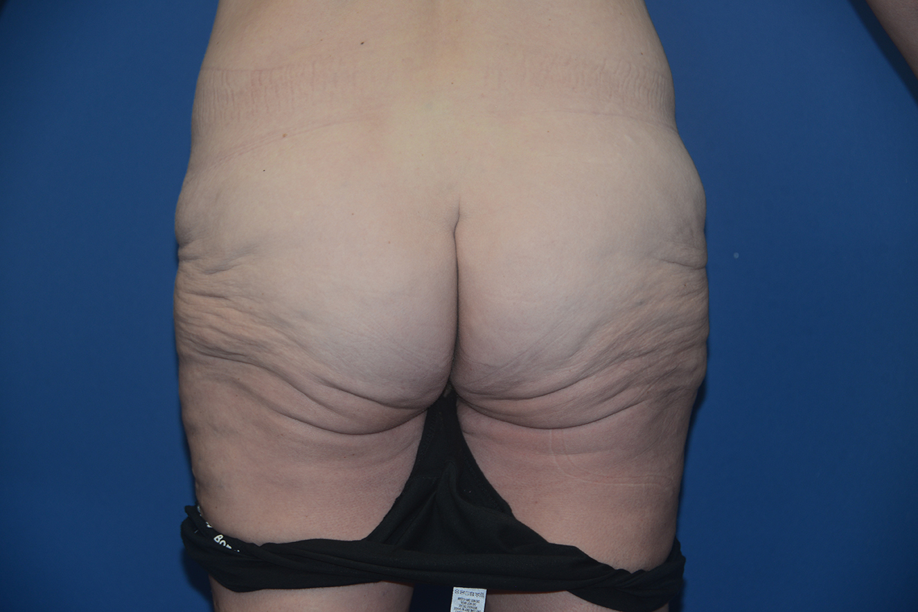 Body lipectomy Case 17