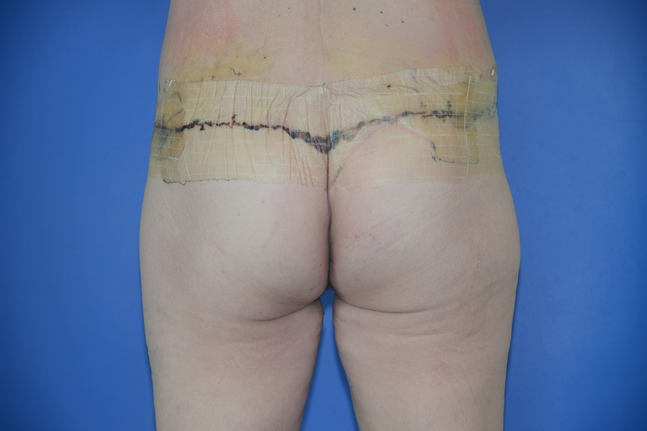 Body lipectomy Case 17