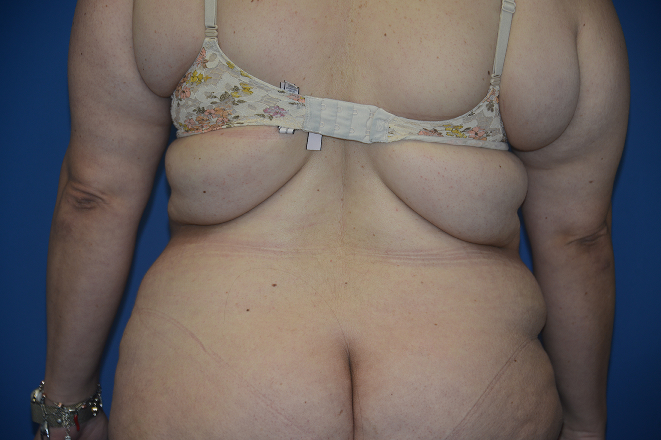 Body Lift Case 18