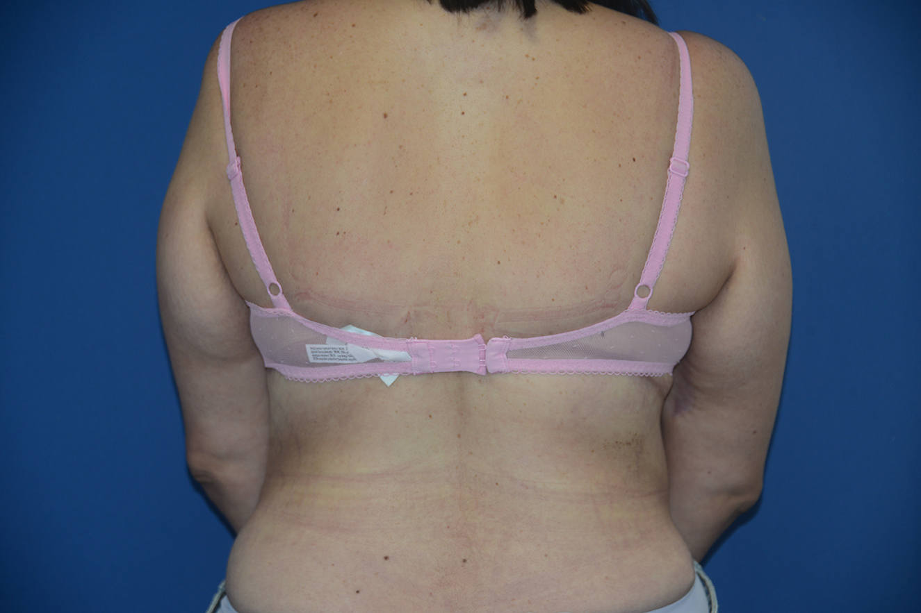 Body Lift Case 18