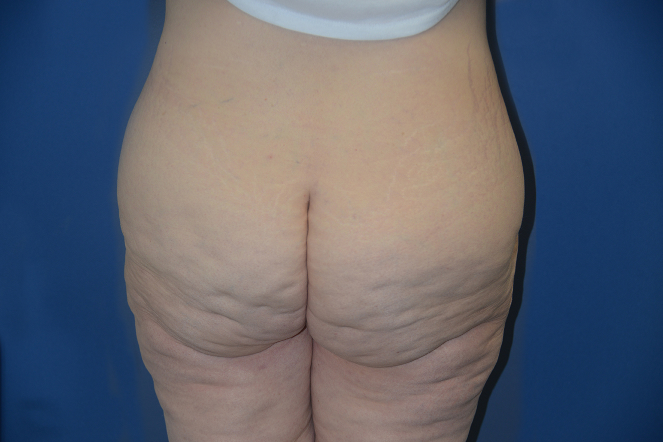 Body Lift Case 19