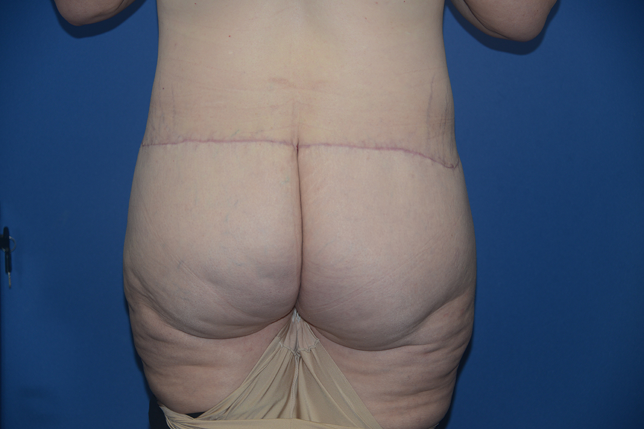 Body Lift Case 19