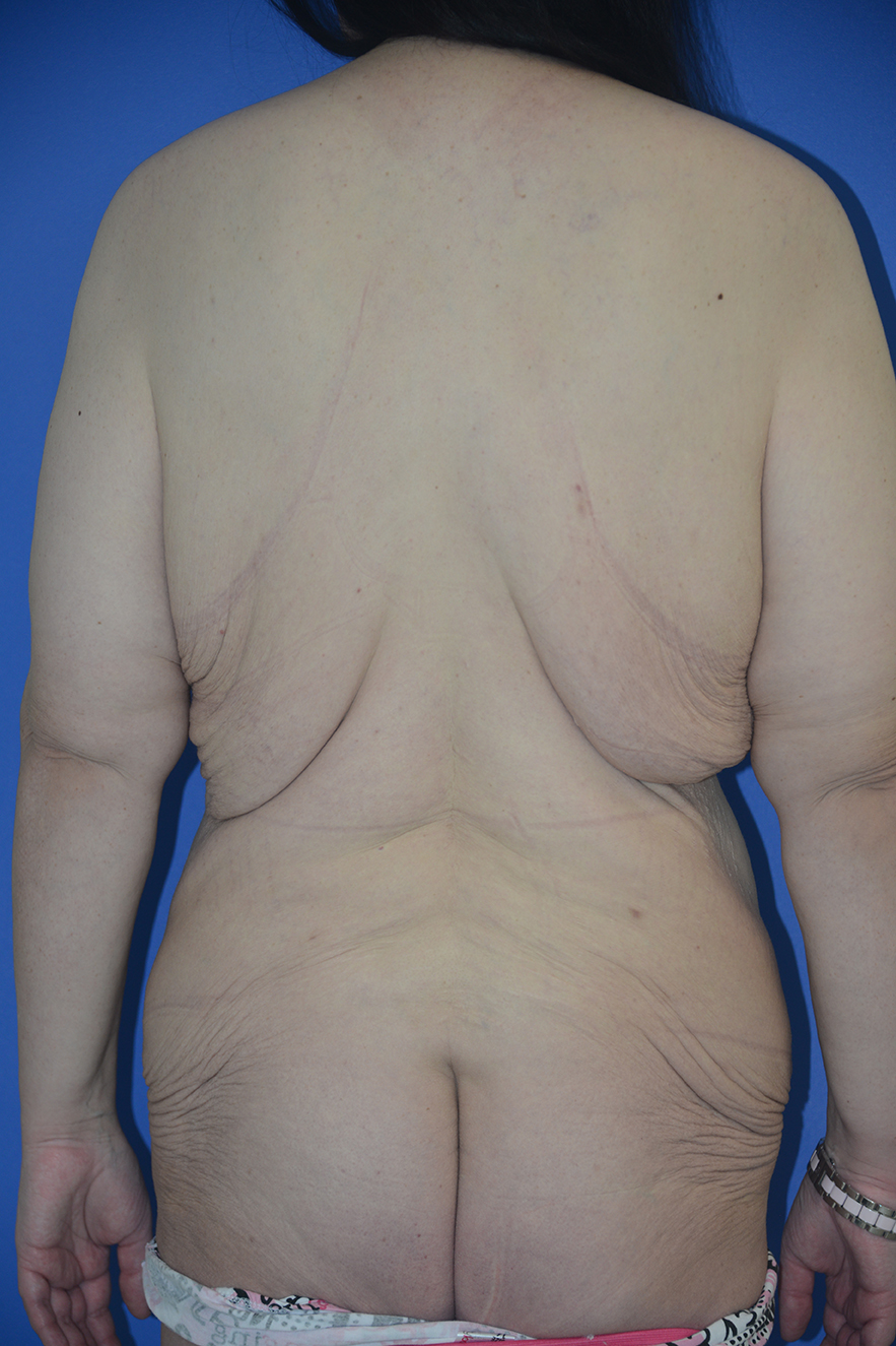 Body Lift Case 20