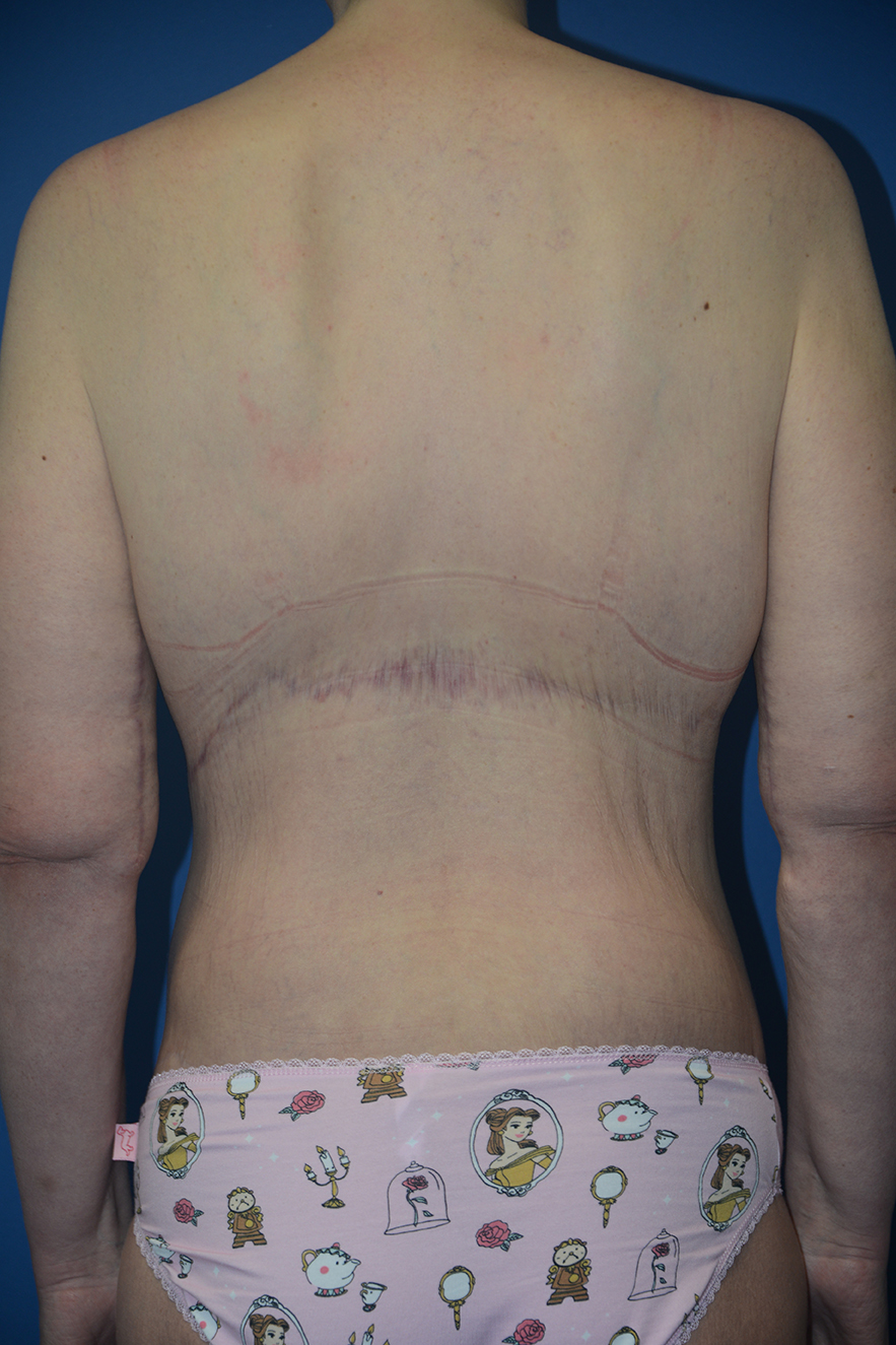 Body Lift Case 20