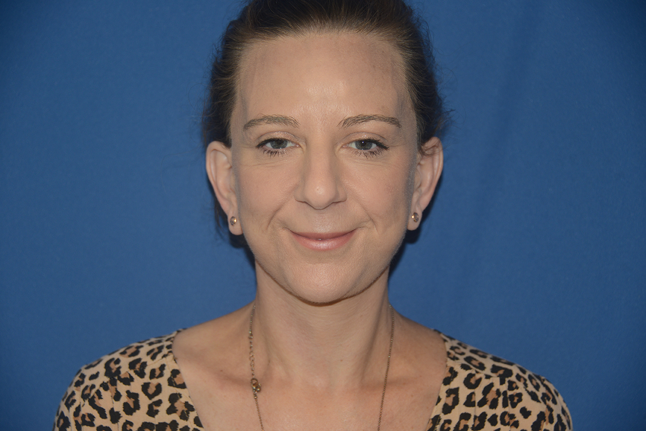 Facelift Case Study 7