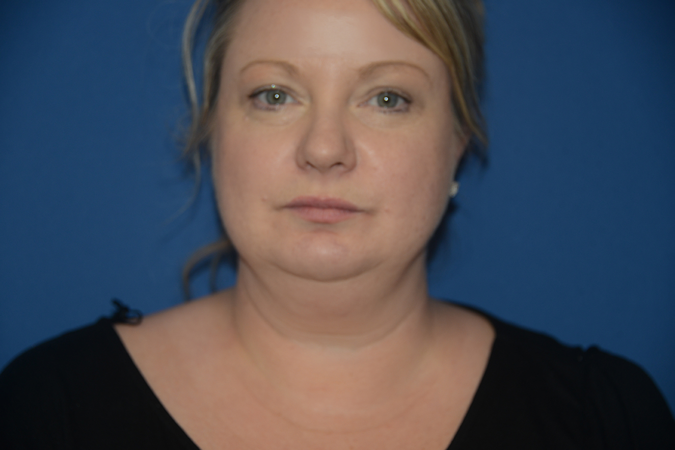 Facelift Case Study 8