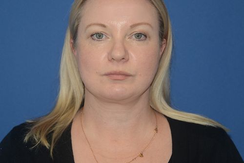 Facelift Case Study 8