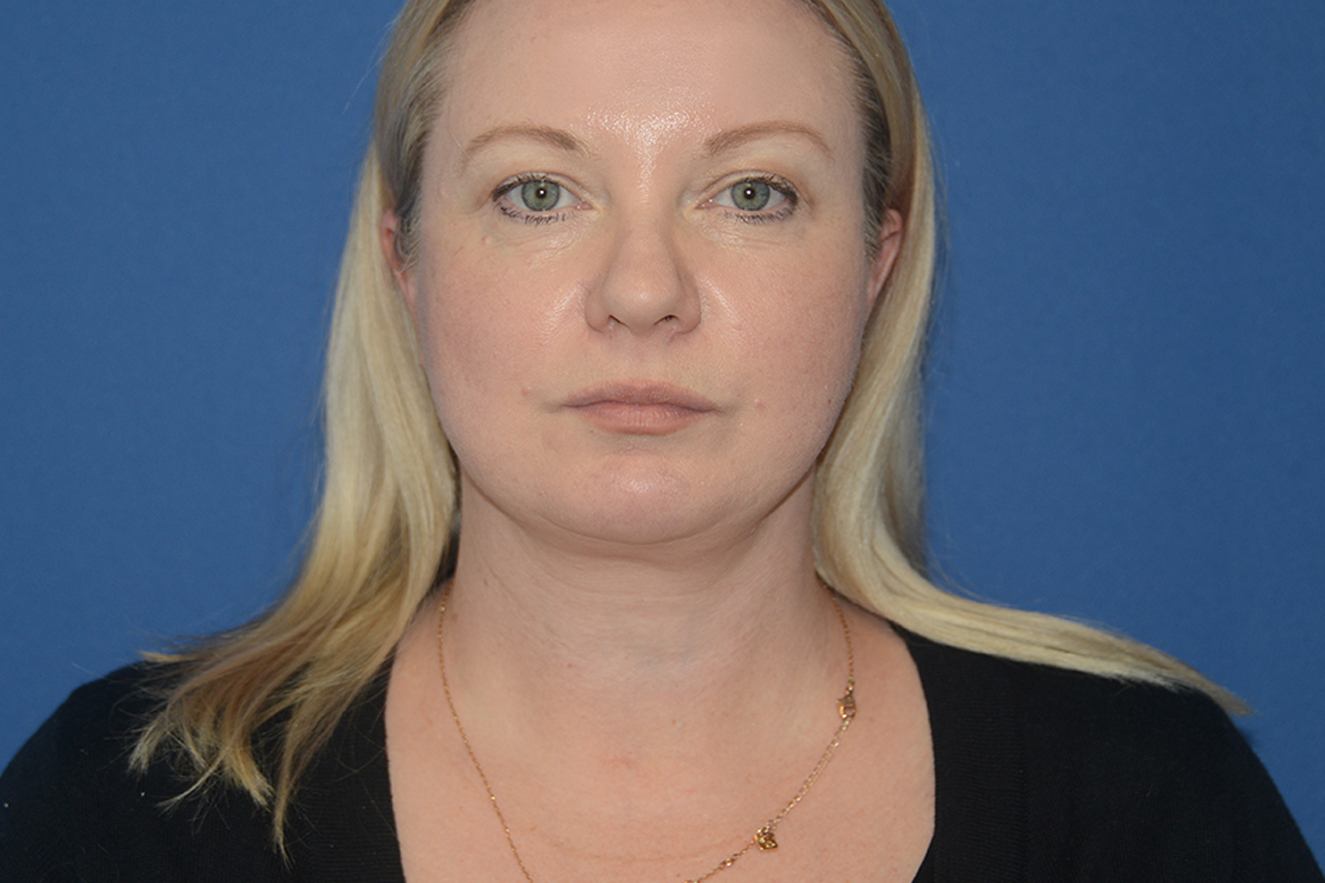 Facelift Case Study 8