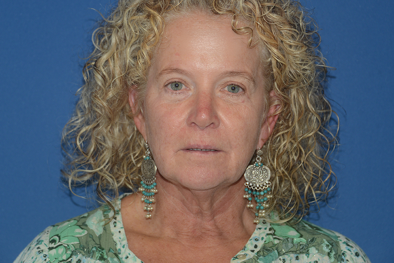 Facelift Case Study 9