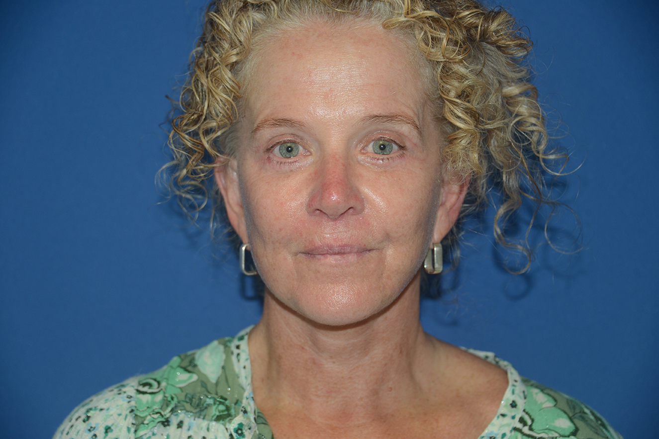 Facelift Case Study 9