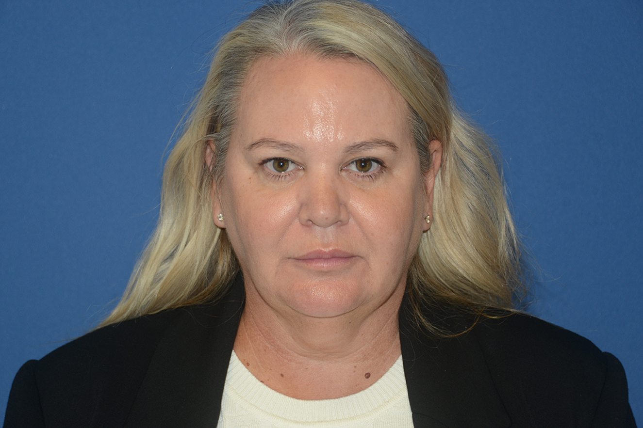 Facelift Case Study 10