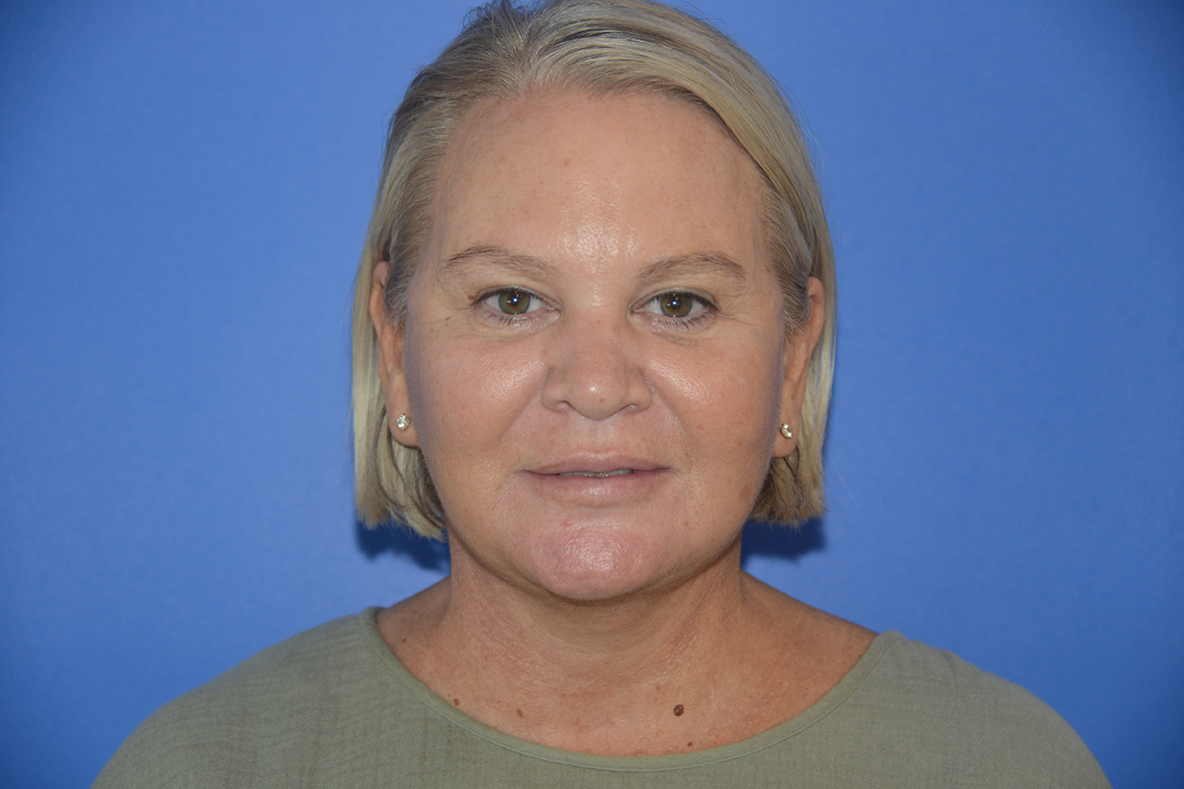 Facelift Case Study 10