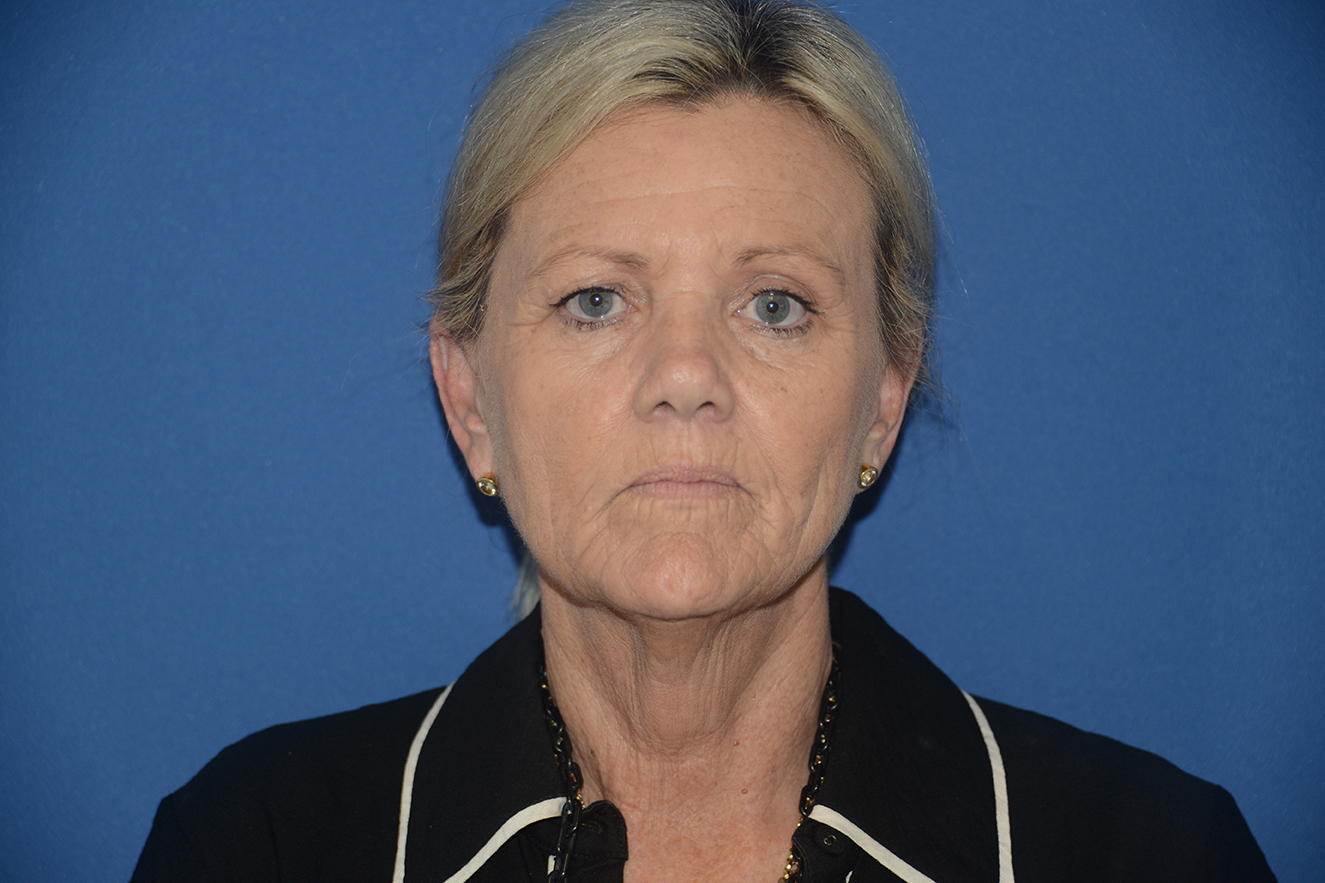Facelift Case Study 11