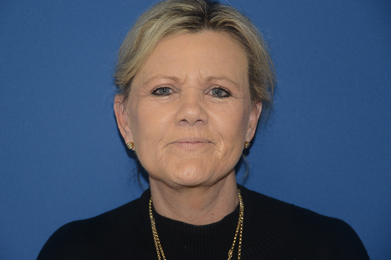Facelift Case Study 11