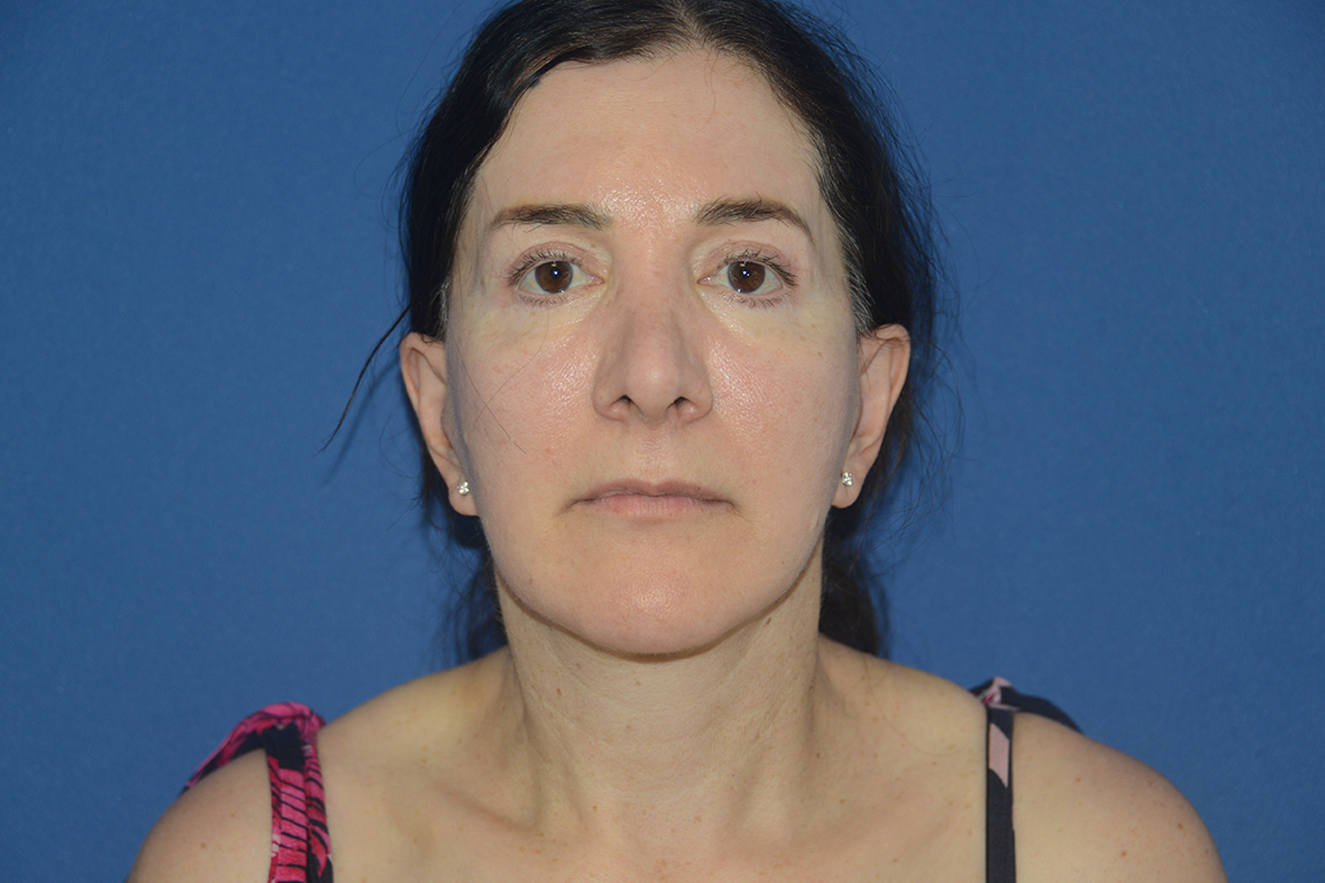 Facelift Case Study 12
