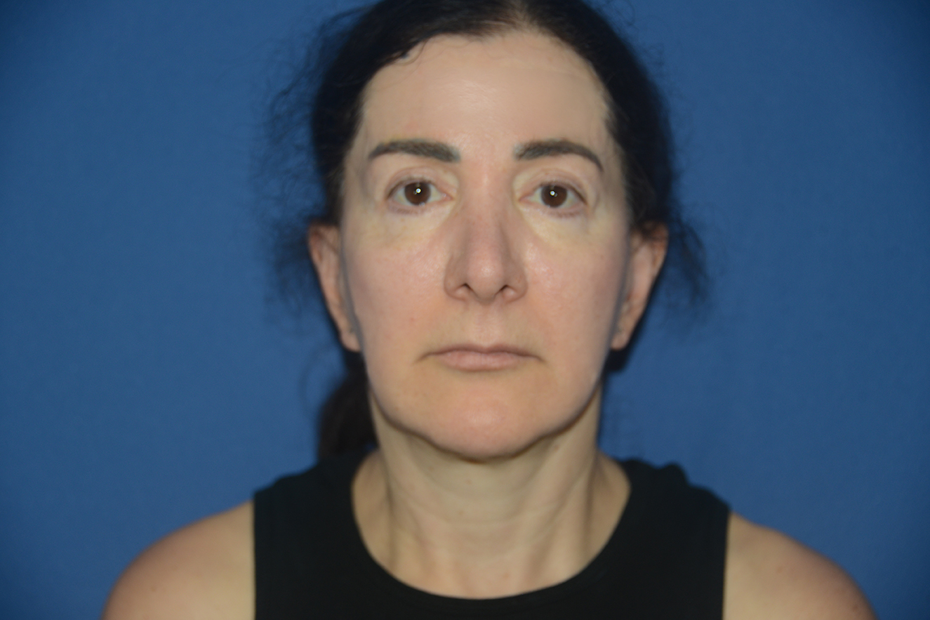 Facelift Case Study 12