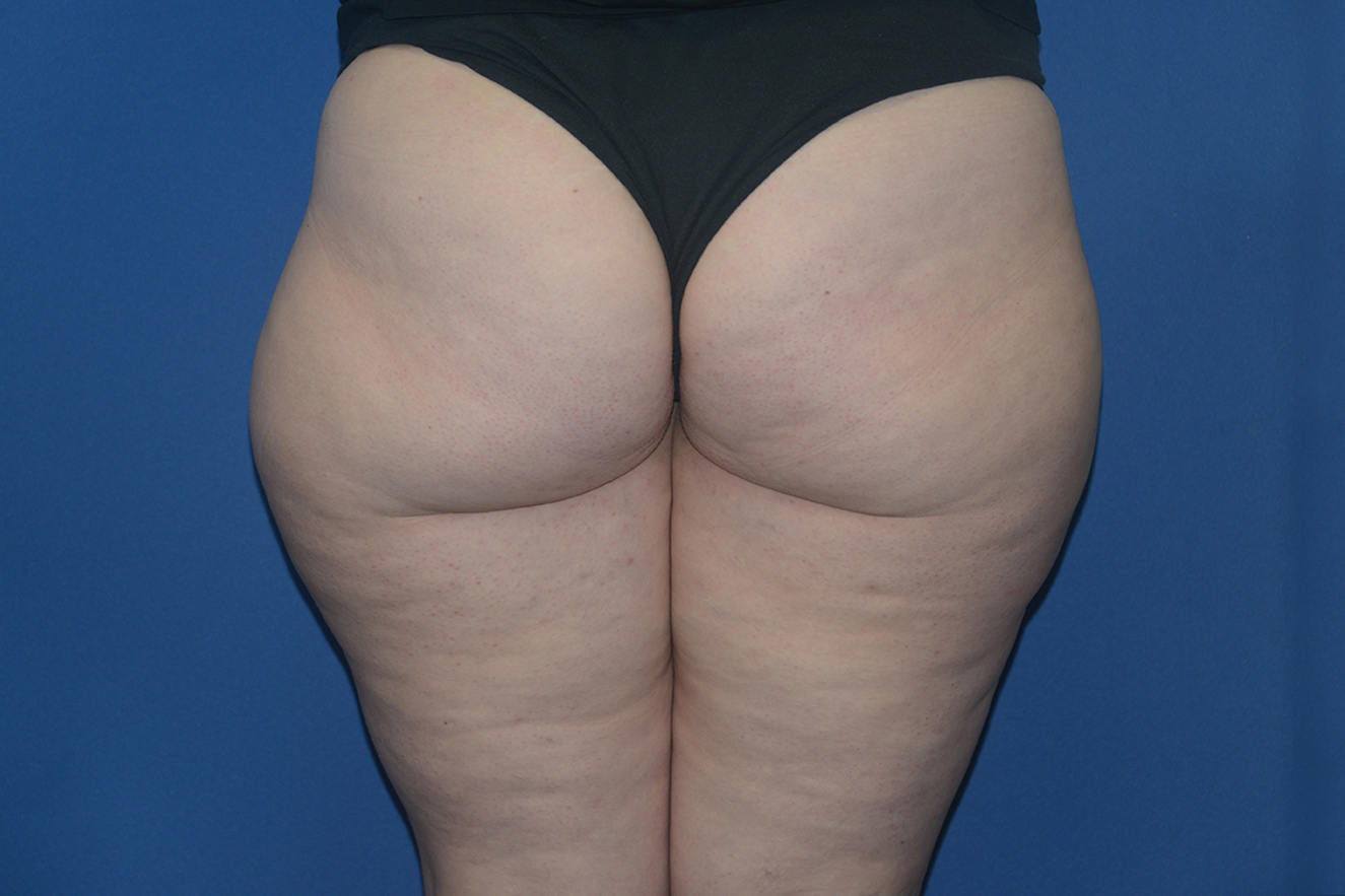 Liposuction Case 16