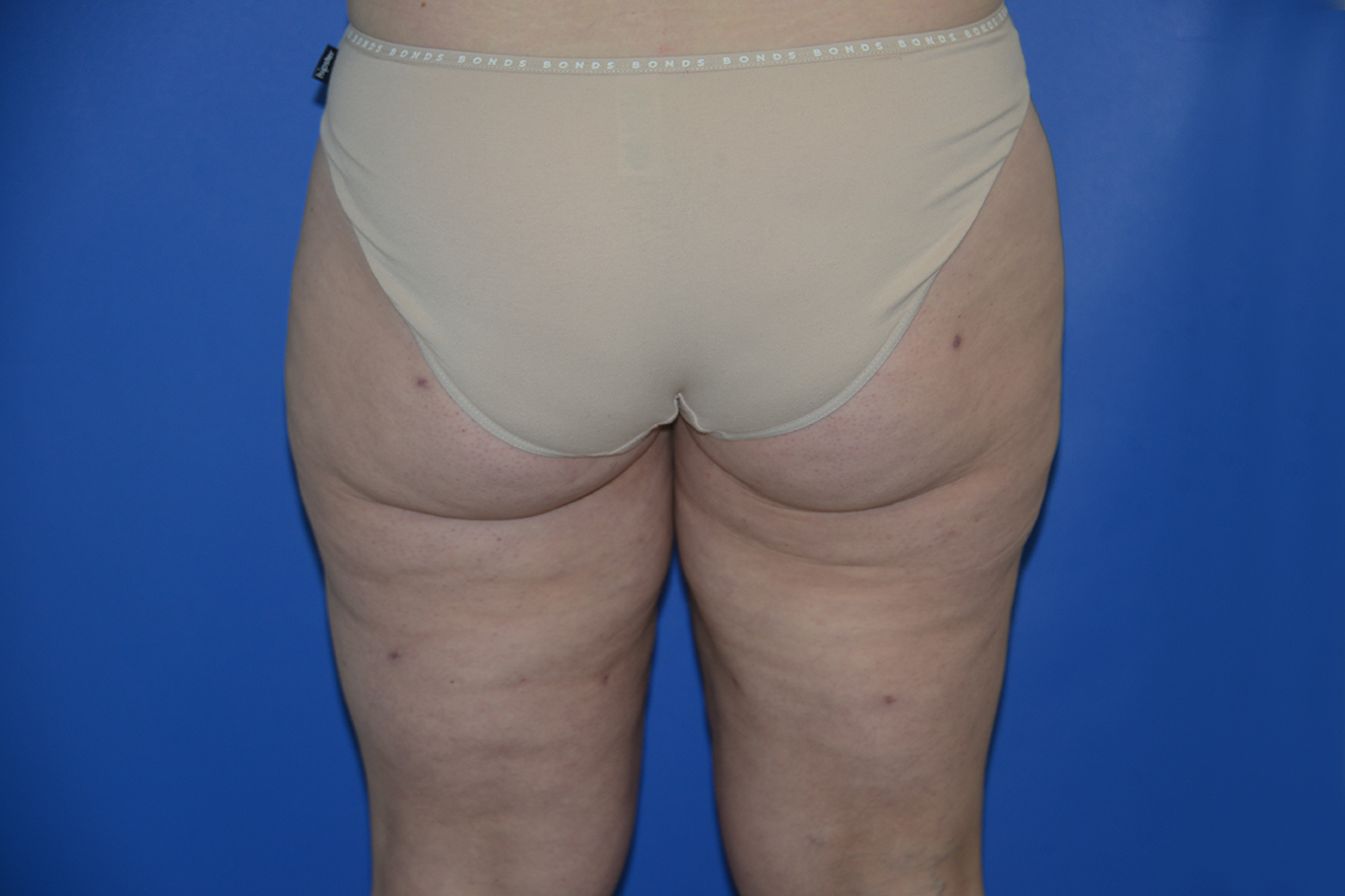 Liposuction Case 16