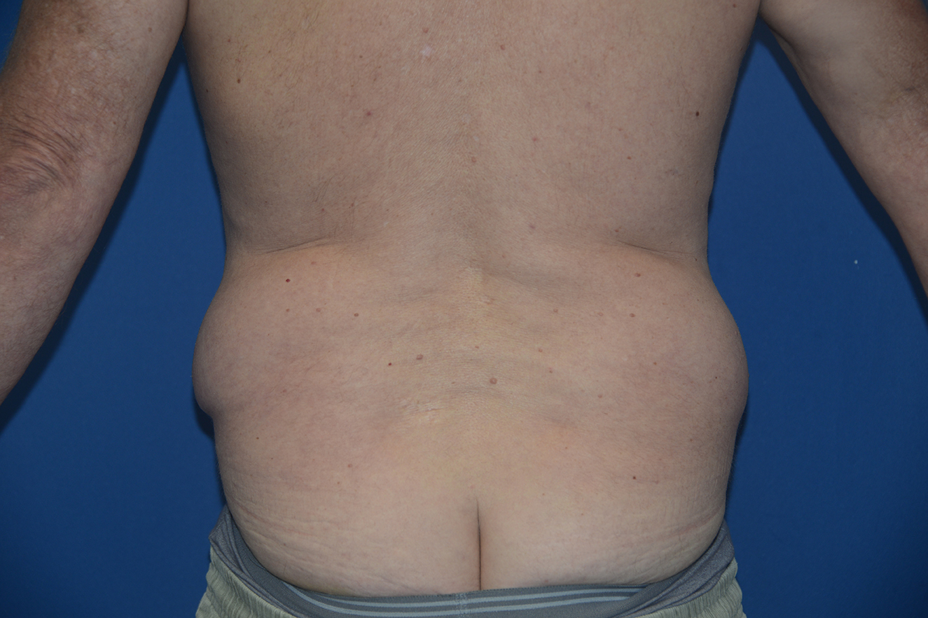 Liposuction Case 18