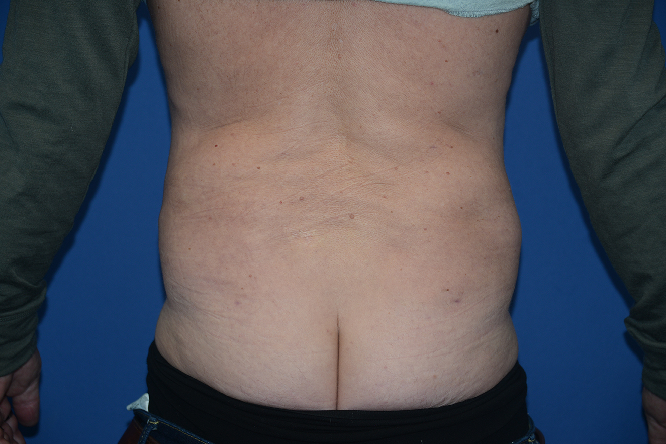Liposuction Case 18
