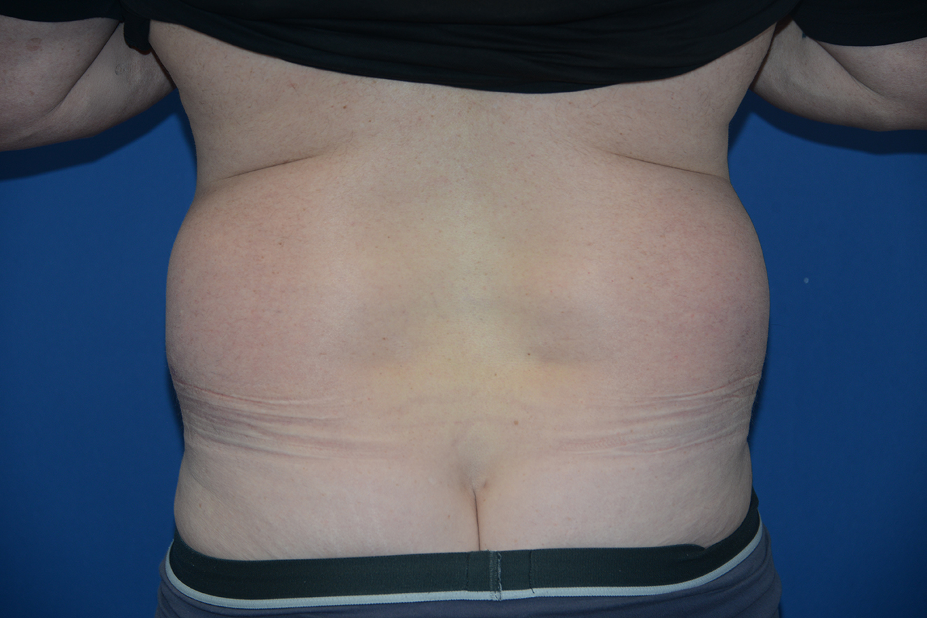 Liposuction Case 19