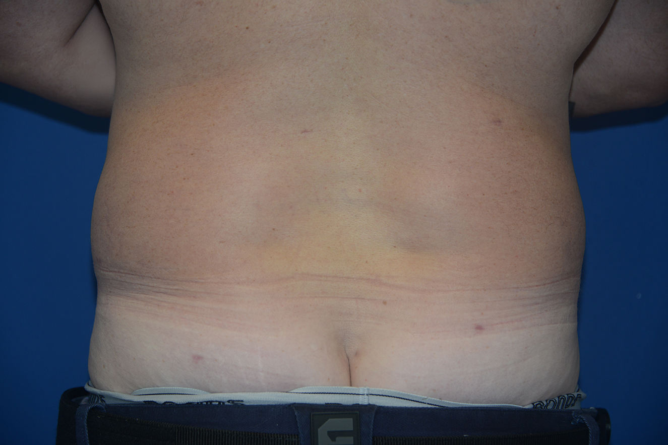 Liposuction Case 19