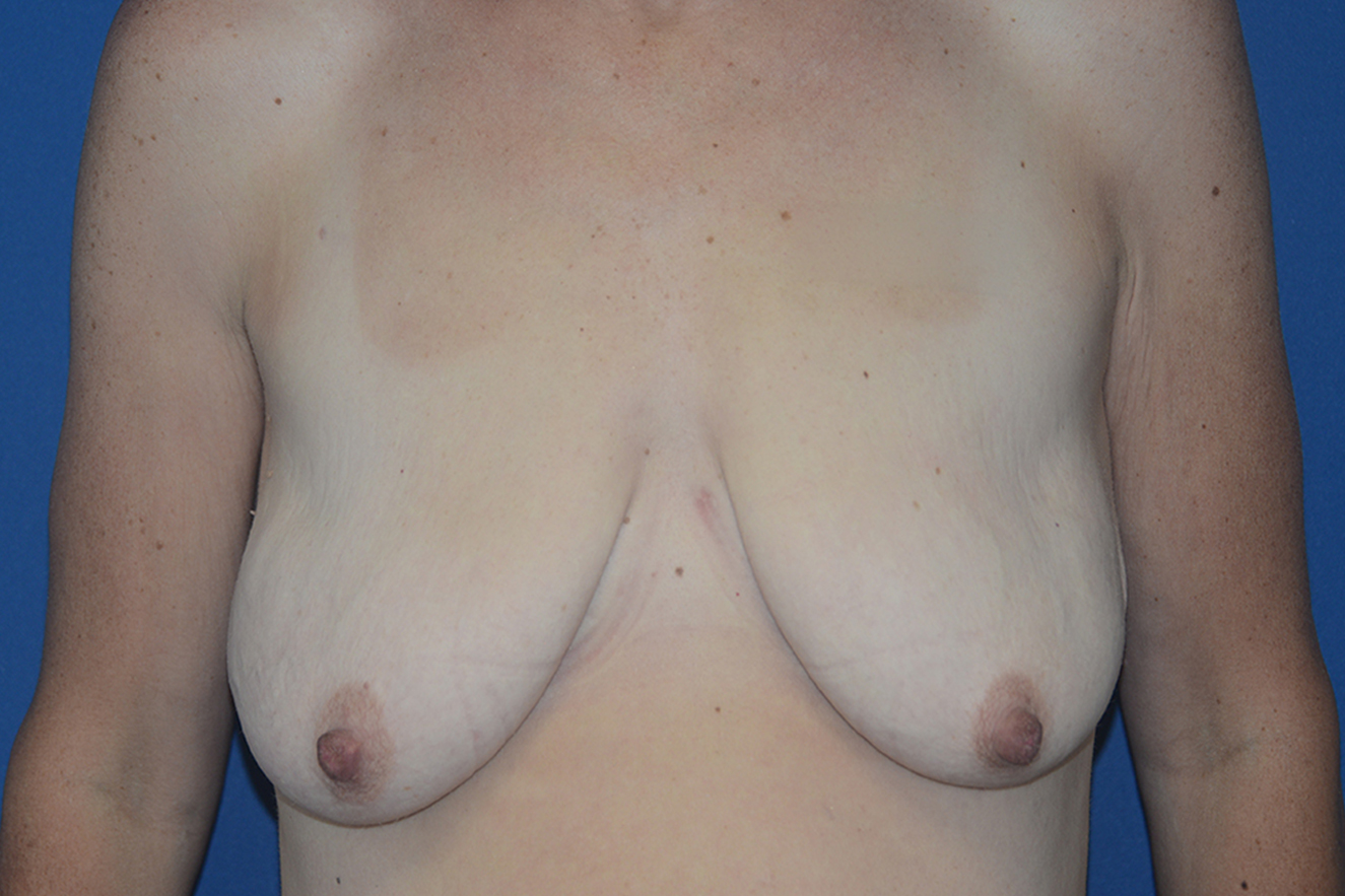 Breast Lift Case 9