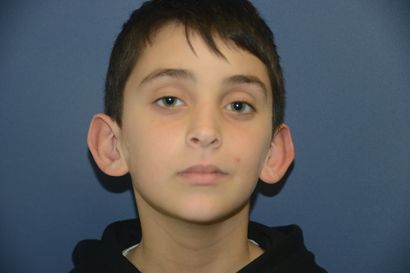 Ear Surgery Case 8